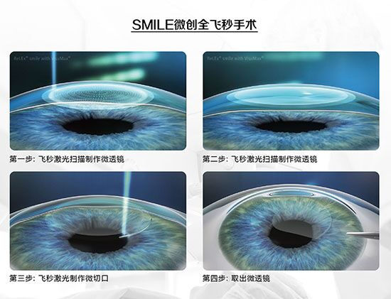 蔡司全飛秒、蔡司半飛秒近視手術(shù)與蔡司全飛秒flex手術(shù)