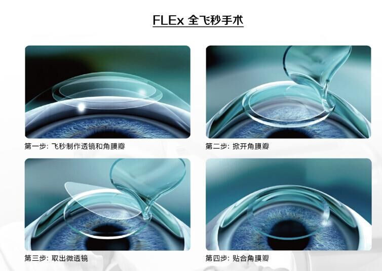 蔡司全飛秒、蔡司半飛秒近視手術(shù)與蔡司全飛秒flex手術(shù)