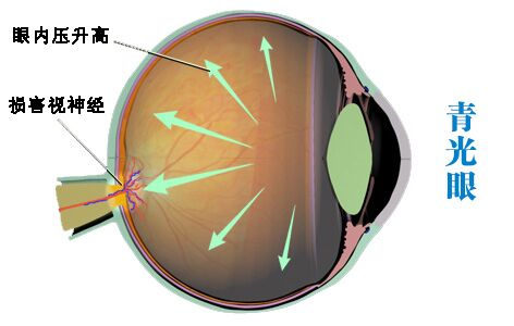 青光眼眼壓是怎么升高的?