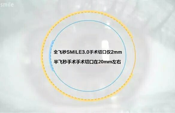 重磅發(fā)布：全飛秒SMILE3.0智能升級(jí)