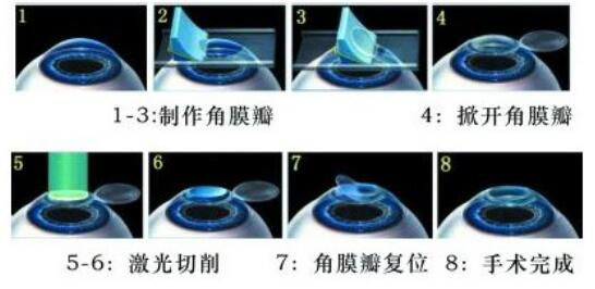 準(zhǔn)分子激光手術(shù)到底是怎么治 愈你的眼睛的？