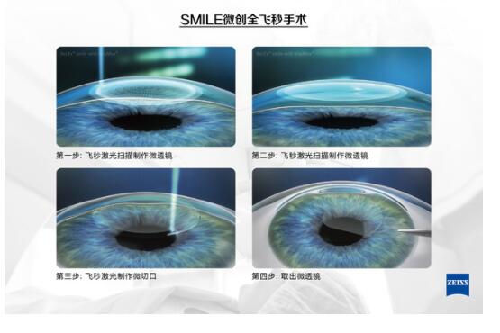 準(zhǔn)分子激光手術(shù)到底是怎么治 愈你的眼睛的？