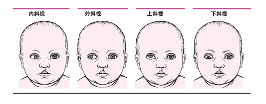 孩子有斜視做手術(shù)矯正有什么危險？