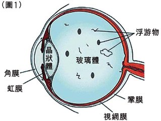 眼前有黑點(diǎn)飄，視物有些變形是什么眼病