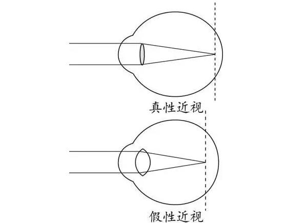 醫(yī)學(xué)小方法：檢測(cè)真性近視還是假性近視