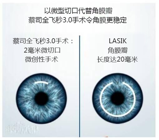 近視手術(shù)有哪幾種？你適合那種快看看